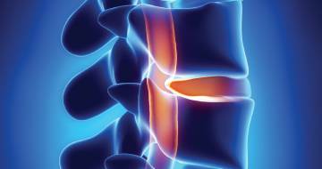Disk Herniations