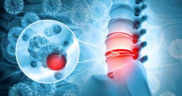 Lumbar Disc Disease