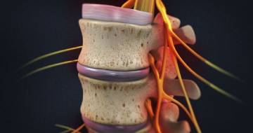 Pinched Nerve
